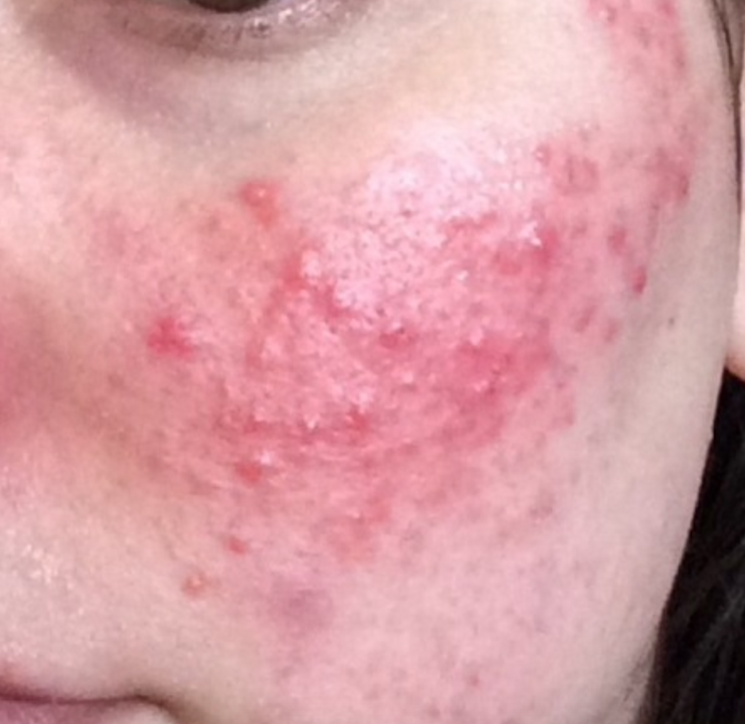 adulta acne and rosacea trigger