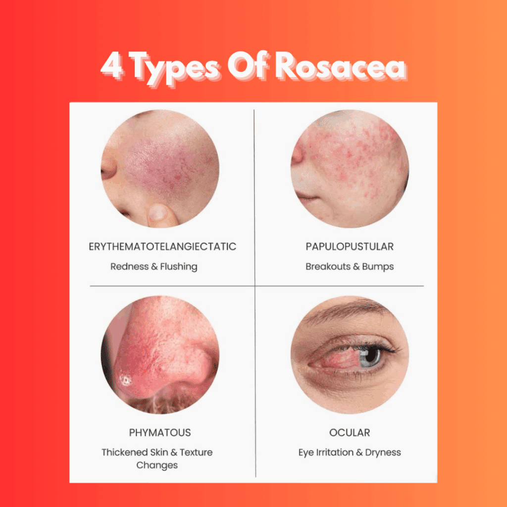 4 types of rosacea