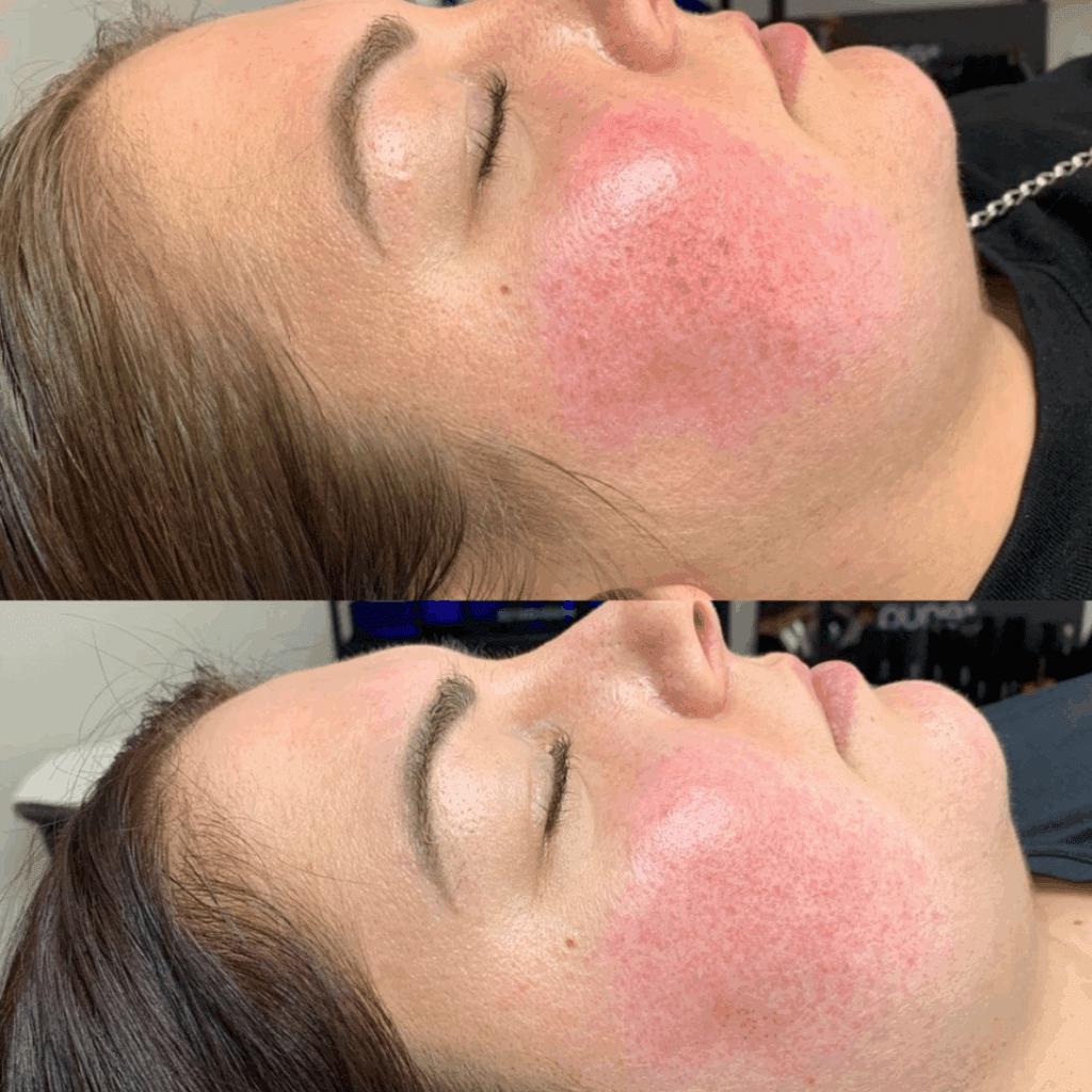 rosacea relief